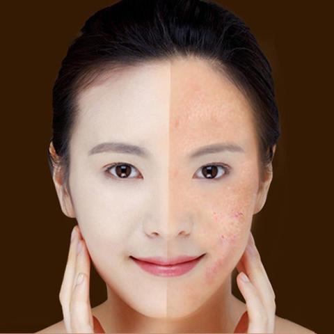Blue Light Therapy Acne Laser Pen Soft Scar Wrinkle Removal Treatment Device Skin Care Beauty Equipment $16.25 Dana Fashion quantity: No logo Beauty Tools Overview: This is a handy photon device for all skincare. It is using the specific 415mm blue light