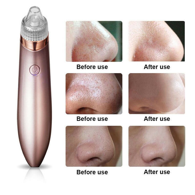Electric Blackhead Vacuum Pore Cleaner Acne Pimple Remover Strong Suction Tool Electric Blackhead Remover Pore Vacuum Suction Diamond Dermabrasion Face Cleaner $25.00 Dana Fashion Color: As Picture Beauty Tools Feature: Can be used to remove blackhead, ac
