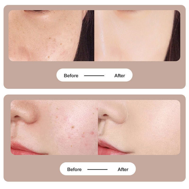 Tattoo Mole Removal Plasma Pen Laser Facial Freckle Dark Spot Remover Tool Wart Removal Machine Face Skin Care Beauty Device $80.15 Dana Fashion Color: 12pinhead Gold Electrical outlet: USB Beauty Tools Overview: 1. Use the latest technology, and microcom